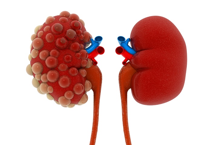 Causes Chronic Kidney Disease