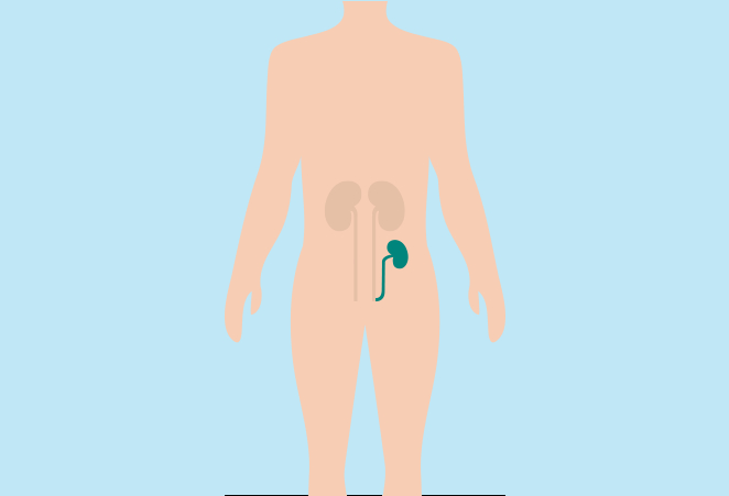 Illustration of a kidney transplant