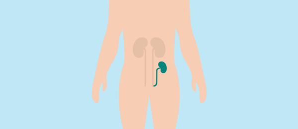 Illustration of a kidney transplant